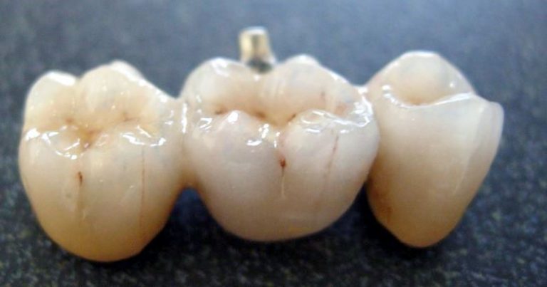 Types of Dental Restorations