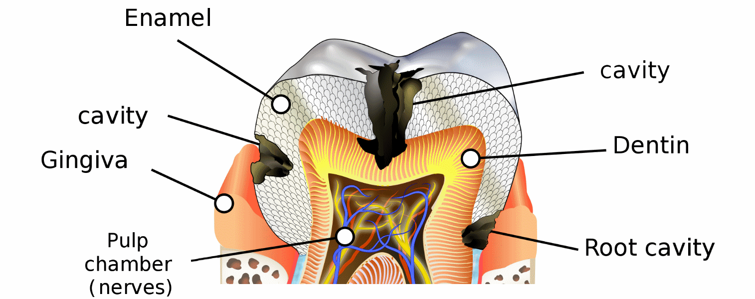 Cavities and Tooth Decay