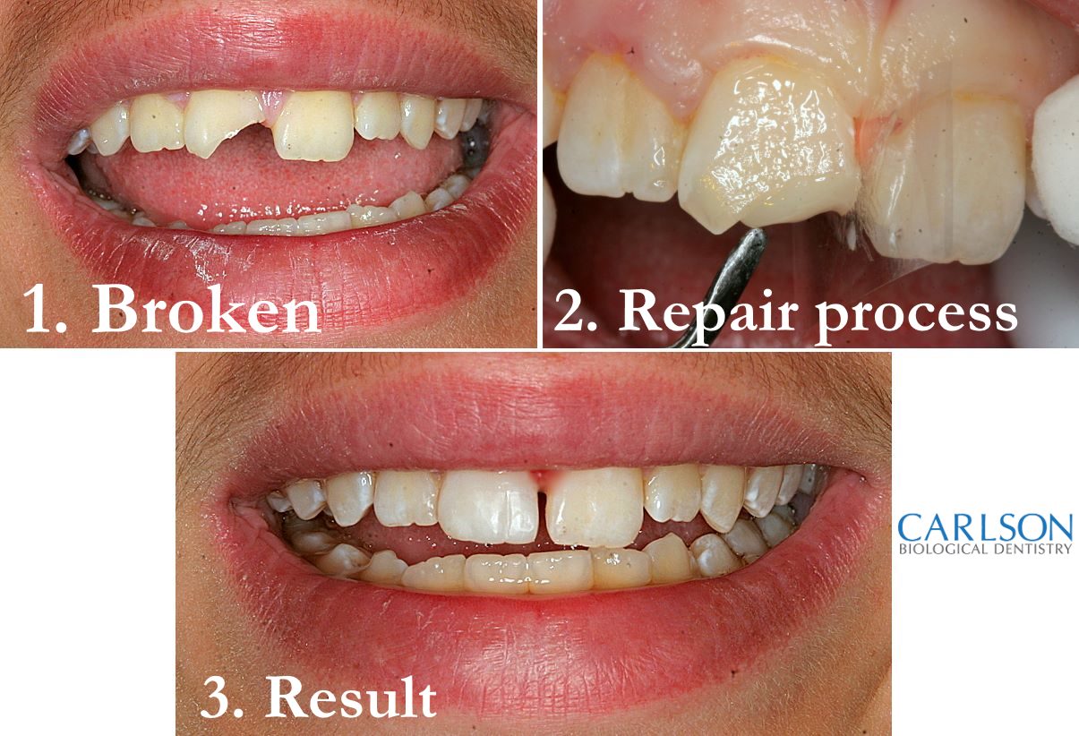glue to fix chipped teeth 3