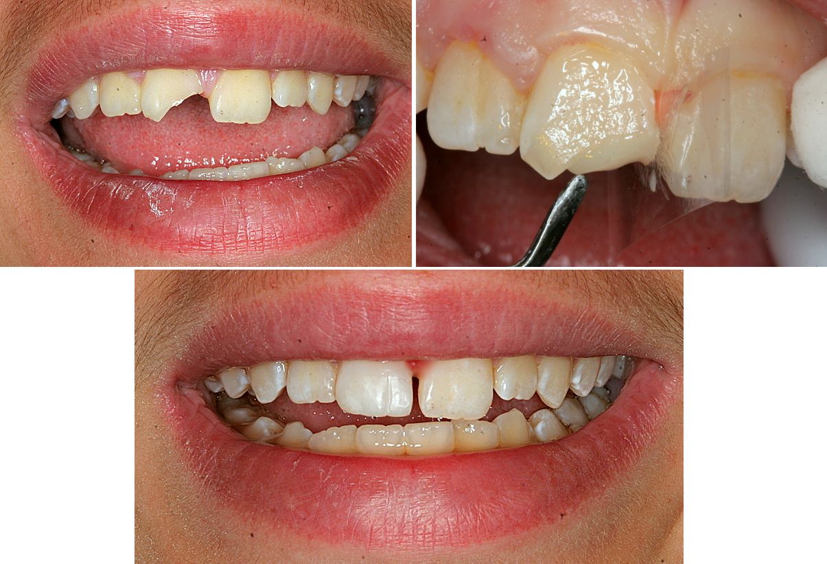 glue-to-fix-chipped-teeth | Kuipers Ortho