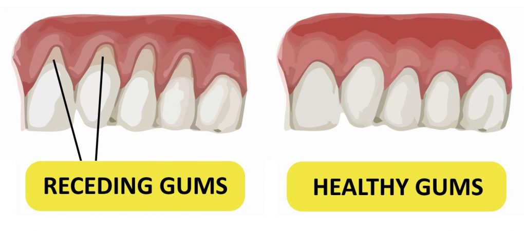 how-to-reverse-receding-gums