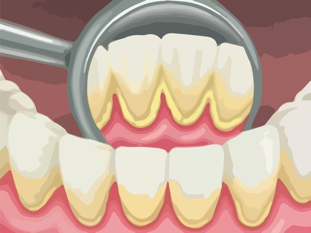 remove-dental-plaque-and-tartar-3 | Kuipers Ortho