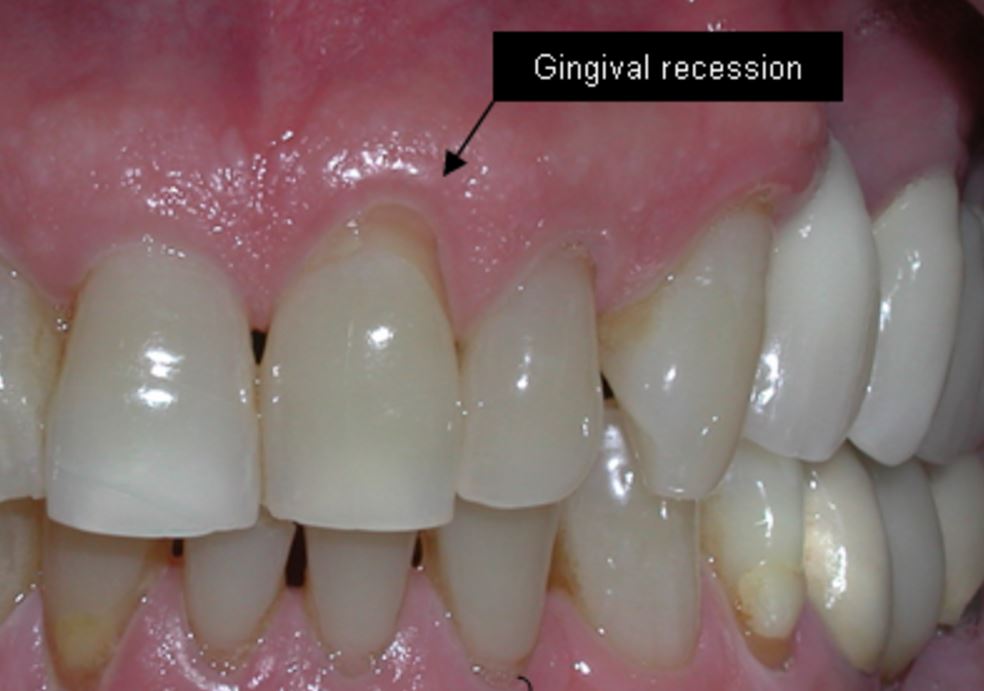 How You Can Stimulate Gum Regrowth Yourself