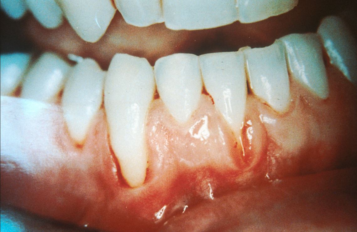 pathological fear of gums