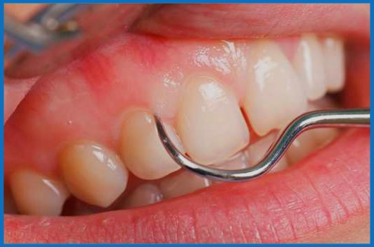 What Are White Gums Causes And Treatment