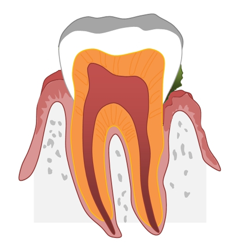 dentalplaqueandgingivitscausingpocketsandrecedinggums Kuipers