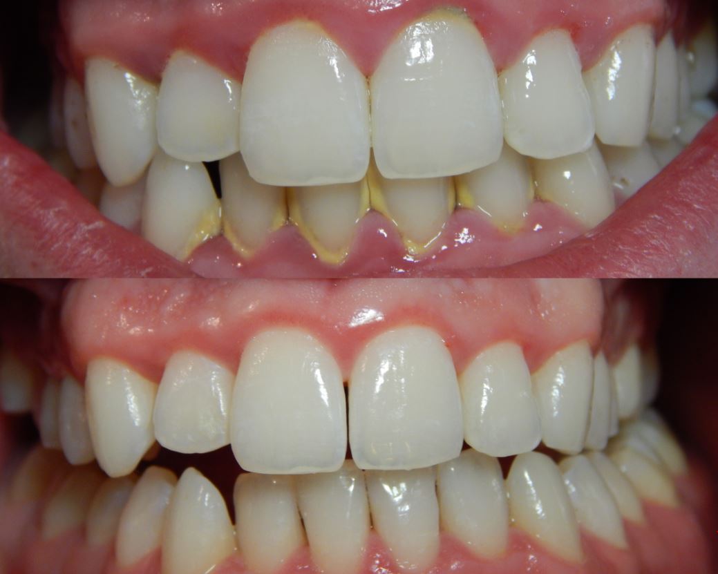 gum-disease-reversible | Kuipers Ortho