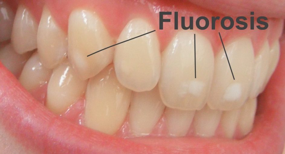 What Causes White Lines On Teeth